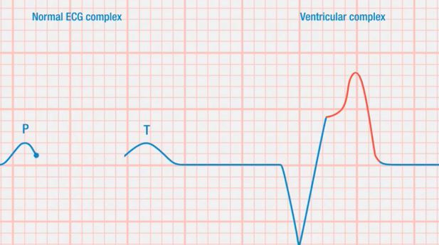 Ecg12