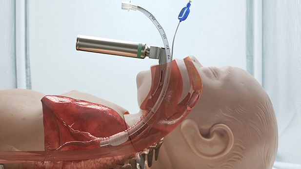 RCVT