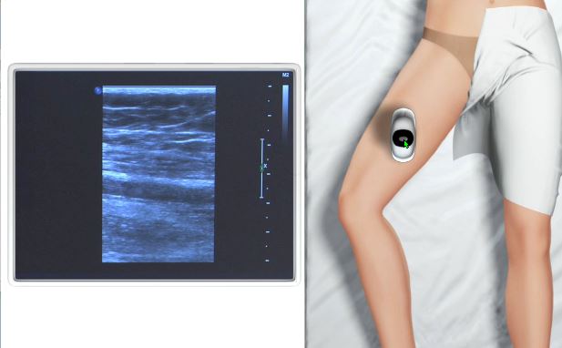 Ultrasound of the Lower Limb Veins for Medical Professionals