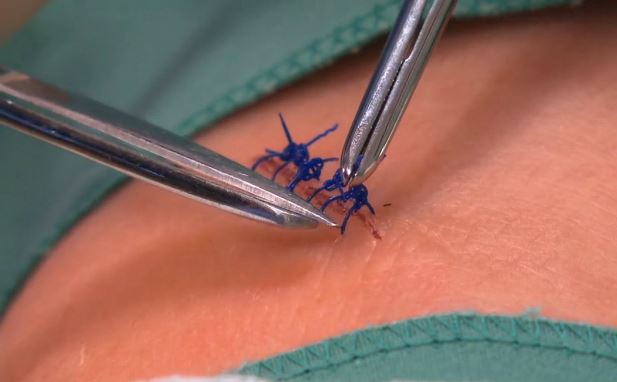 Suture Removal for Medical Professionals