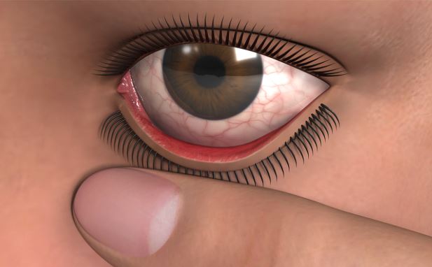 Irrigate the Eye and Instill Eye Medication for Medical Profes...