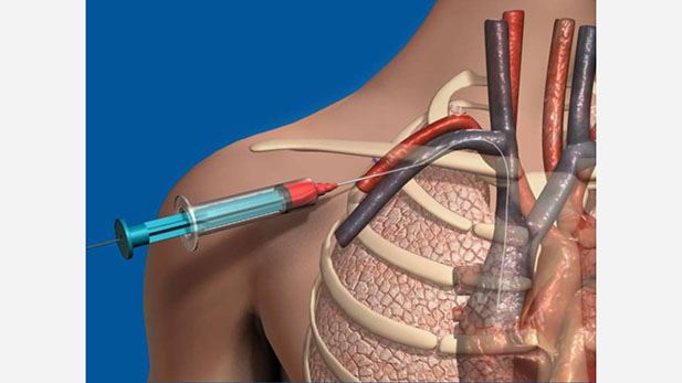 Central Venous Catheterization – Subclavian for Medical Profes...